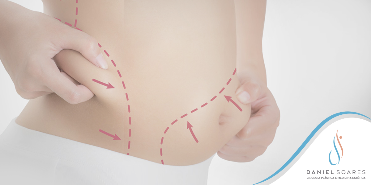 Cirurgia de abdominoplastia: como é feita, pré e pós-operatório.